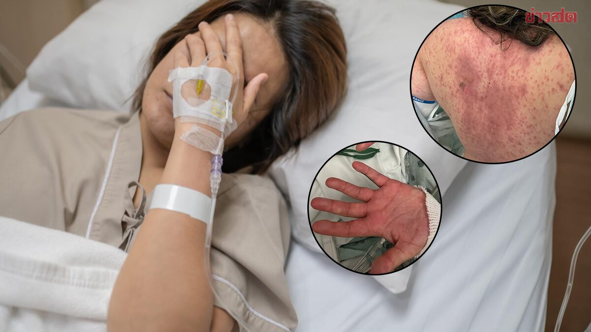 30-Year-Old American Woman Loses Eyesight and Suffers 87% Skin Loss After Severe Medication Reaction