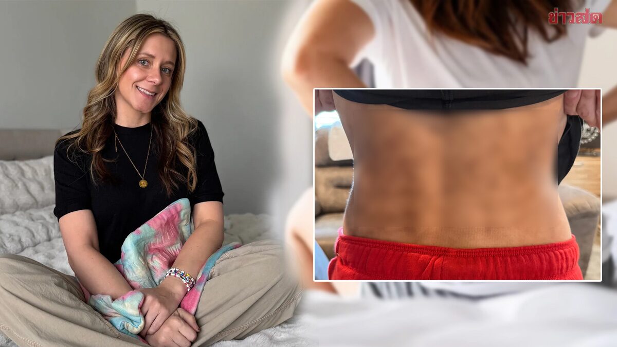 Woman Reveals 6-Year Hot Compress Addiction Leads to Skin Damage