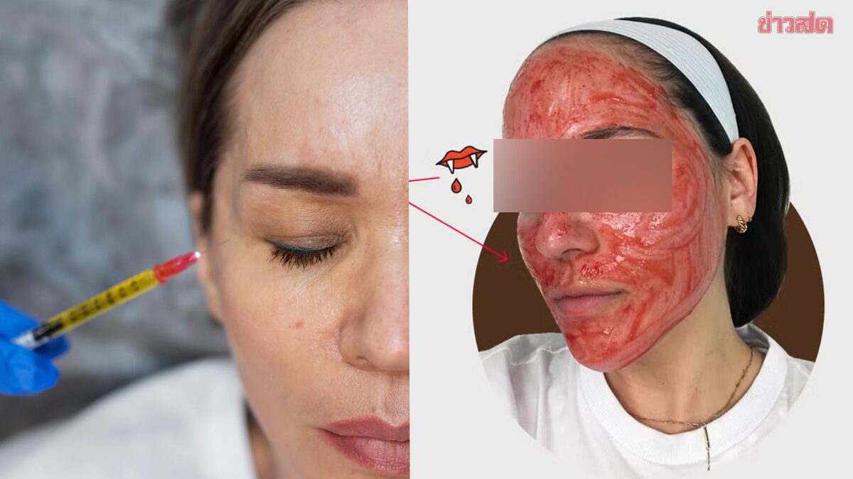 Beauty at a Cost: Experts Warn of HIV Transmission Risk in PRP Treatment