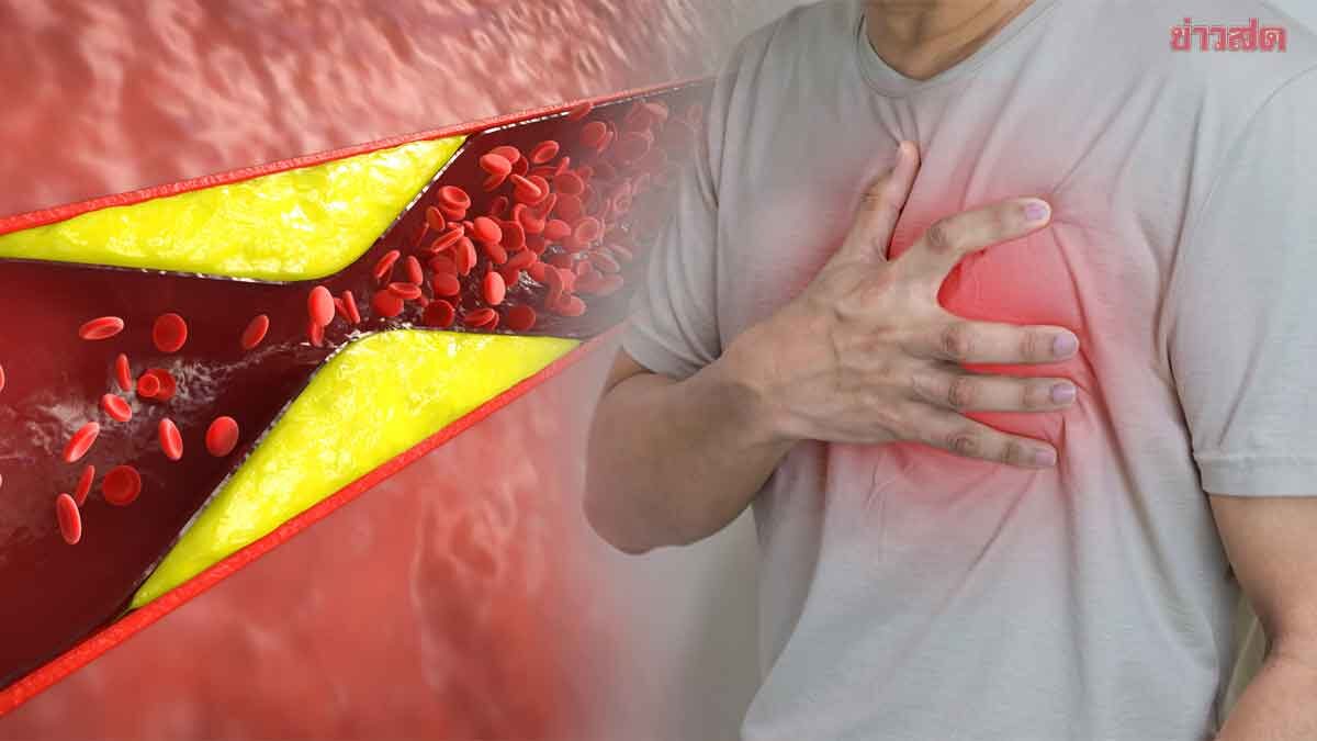 Urgent Check! 5 Warning Signs of Blood Fat Blockage, Most Cases Have No Symptoms Until Heart Attack or Stroke