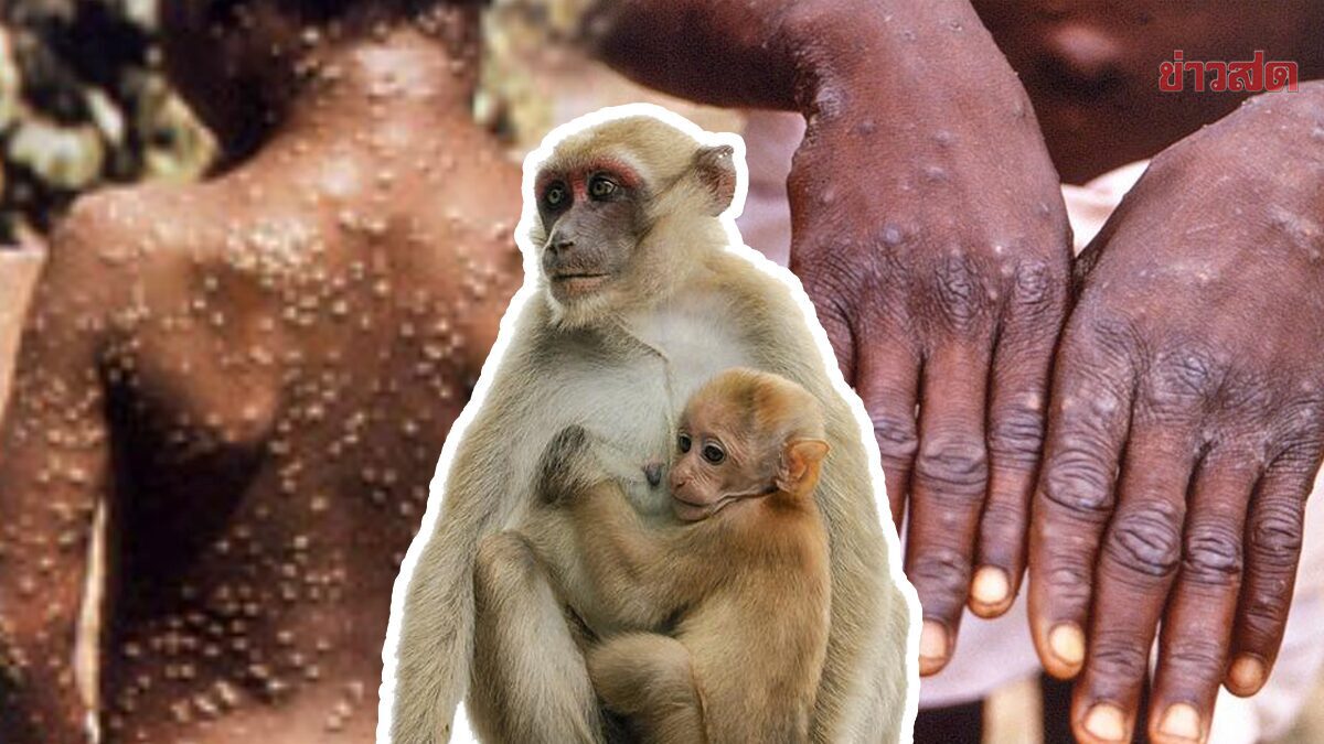 Disease Control Department Finds 2 More Monkeypox Cases in Prison, Confirms Situation is Contained