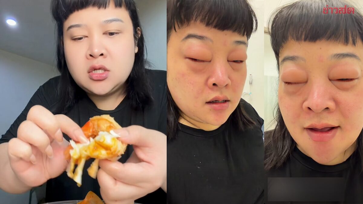 Food Influencer Warns Followers: Don't Copy My Shrimp Allergy Experience