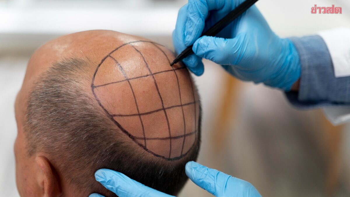 คลินิกปลูกผมราคาถูกเสี่ยงพัง แนะวิธีเลือกให้ได้มาตรฐาน