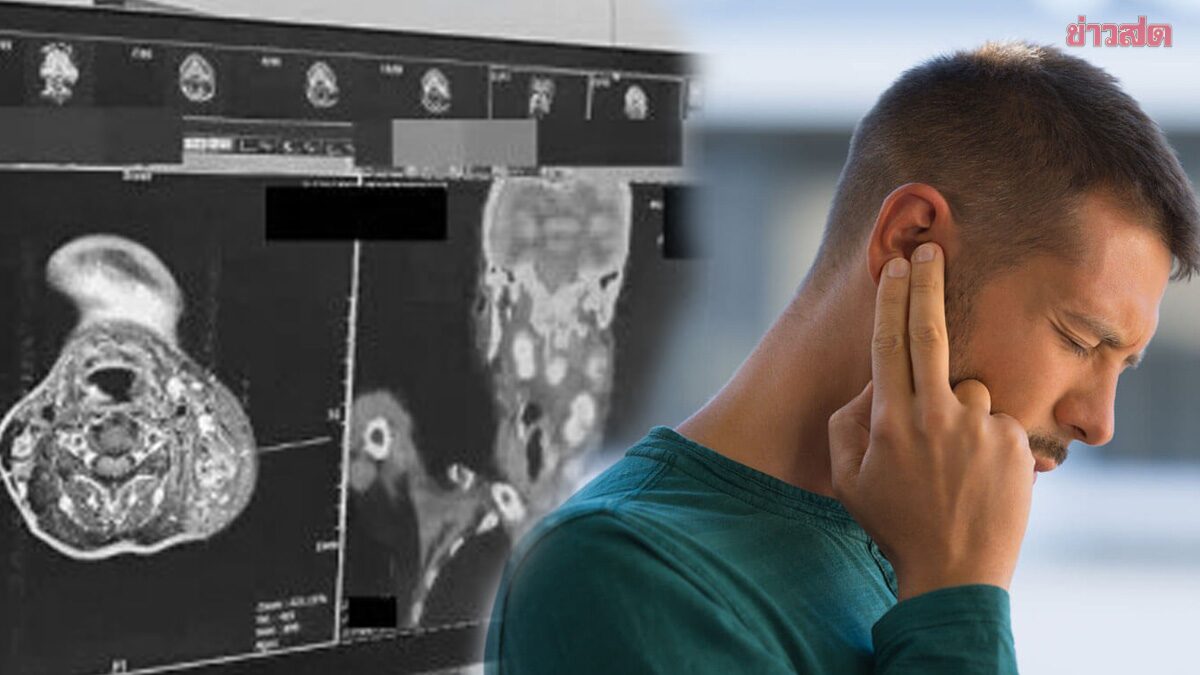 ชายไต้หวัน คิดว่าแค่หูตึง สุดท้ายตรวจเจอมะเร็งระยะ 3 แพทย์เตือนอย่าชะล่าใจ