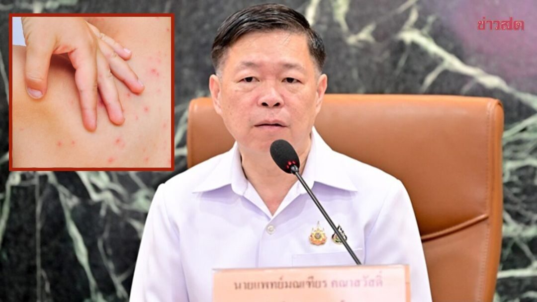 .กรมควบคุมโรค ติดตาม 'อีสุกอีใส' พบผู้ป่วยกว่า 1 หมื่นคน ติดใน กลุ่มเด็กเล็ก-เด็กวัยเรียน.