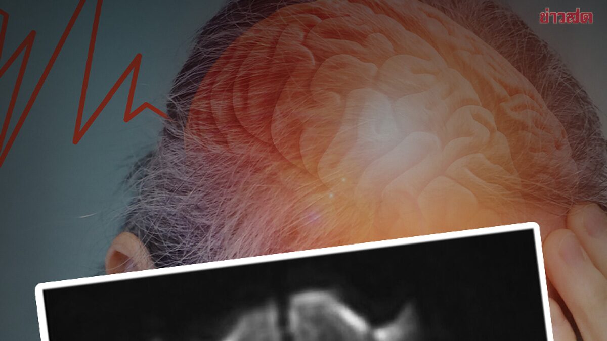 หมอเจด เตือน 7 พฤติกรรมก่อนนอน ที่คิดว่าปกติ เสี่ยง “สมองขาดเลือด”