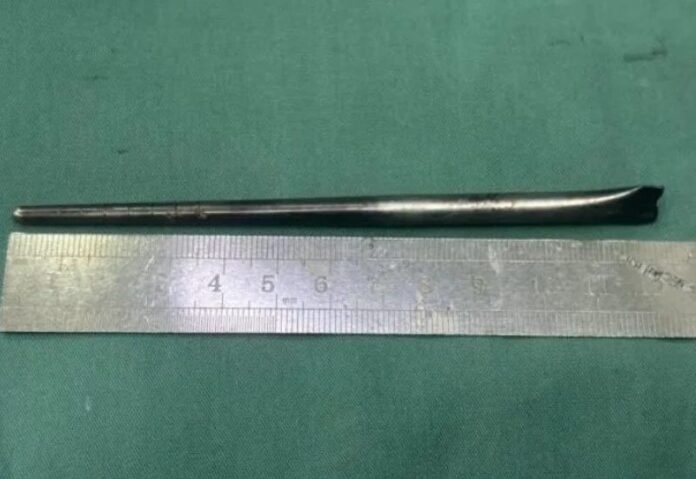 ตะเกียบโลหะความยาวประมาณ 12 เซนติเมตรฝังอยู่ภายในลำคอ