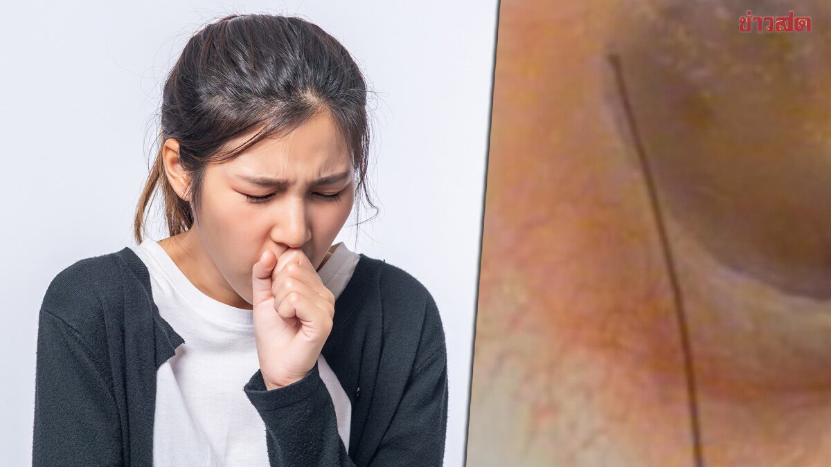 เปิดเคส หญิง 70 ปี ไอเรื้อรังมานาน คิดว่าเป็นภูมิแพ้ ที่ไหนได้มีเส้นผมติดเยื่อแก้วหู แพทย์เอาออกอาการหายเลย