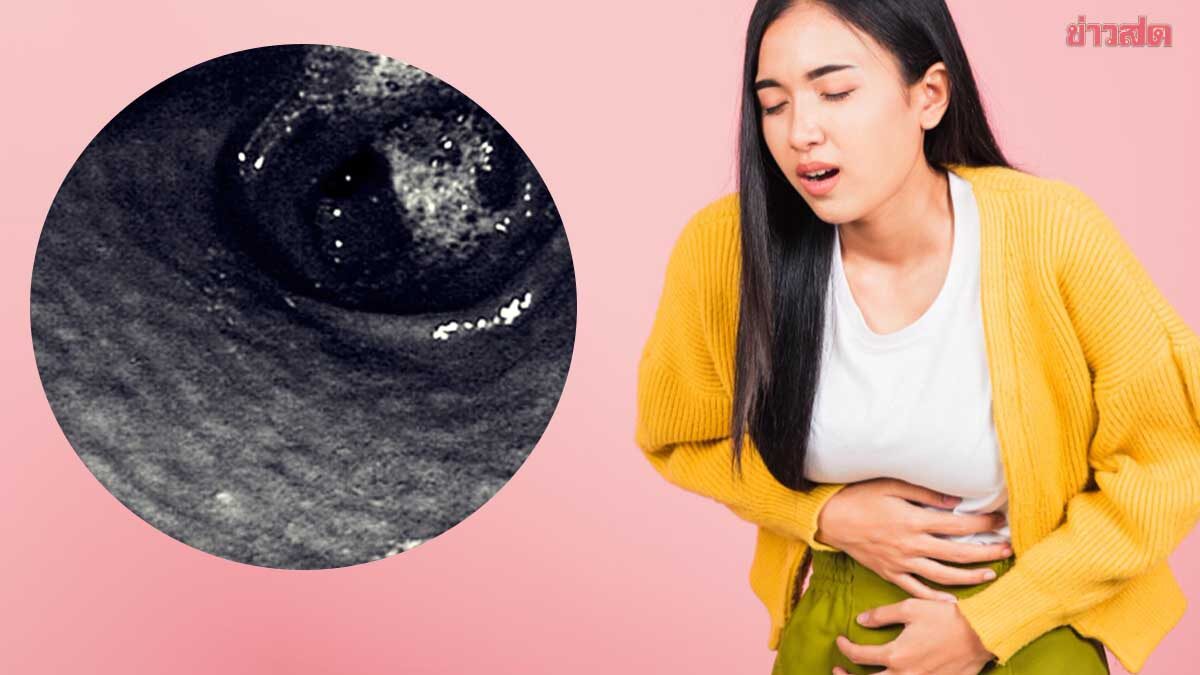 เด็ก 15 ปีอาเจียนเป็นเลือด ส่องกล้องพบ ลักษณะเป็นปุ่มนูน ในกระเพาะอาหาร