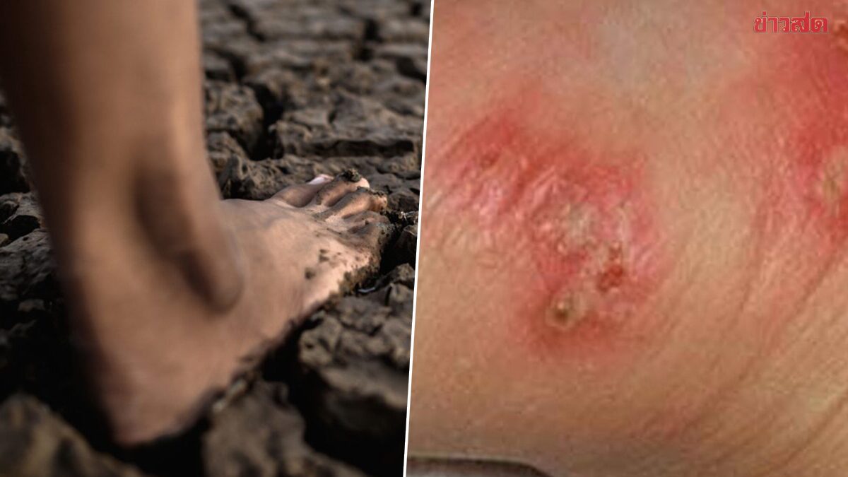 เตือนเฝ้าระวัง “โรคเมลิออยด์โดสิส” พบผู้ป่วยสะสม 732 ราย เสียชีวิต 23 ราย เผยอาการ