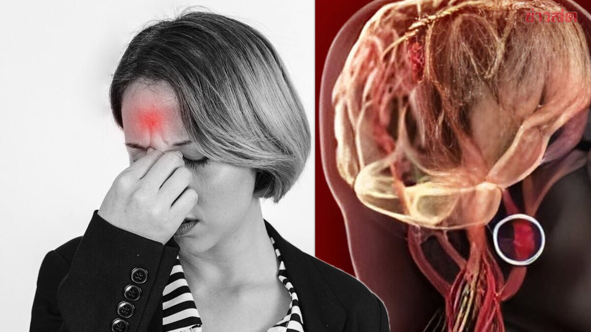 ไม่อยาก “เส้นเลือดสมองตีบ” ให้ทำแบบนี้ หมอ เผย สัญญาณเตือน