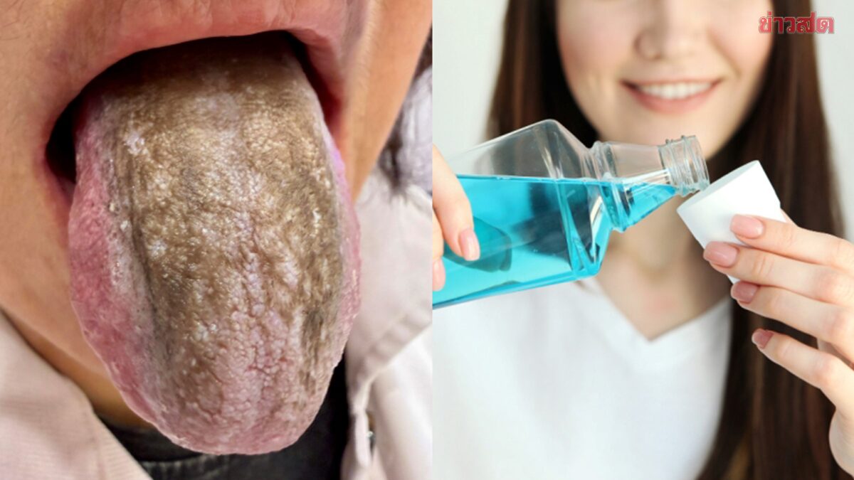 หญิงลิ้นกลายเป็นสีคล้ำ หลังบ้วนปากวันละ 5 ครั้ง เหตุอยากกำจัดเชื้อแบคทีเรีย