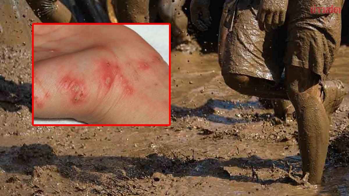 ย่ำน้ำ-ลุยโคลน ต้องระวัง! ‘โรคเมลิออยด์โดสิส’ ติดง่าย ลามไว อันตรายถึงตาย