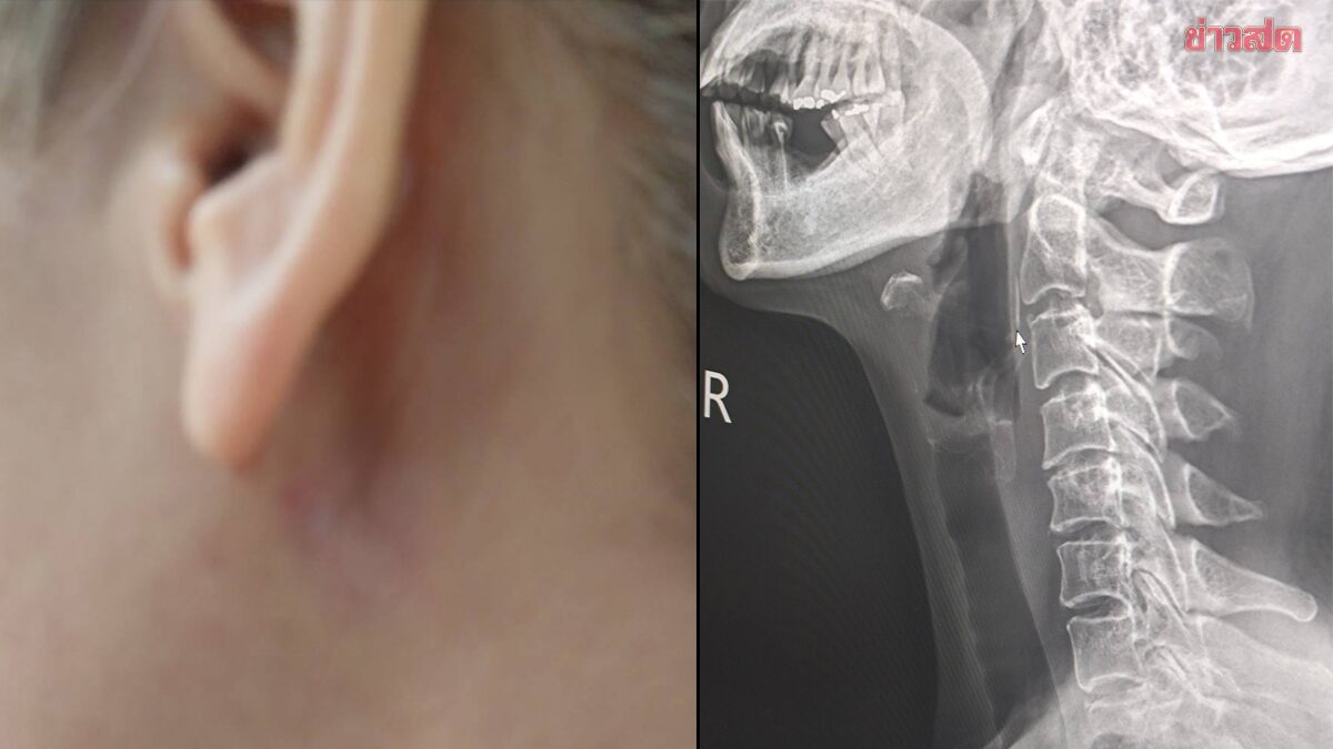 หญิงแชร์เรื่องขนลุก ‘ก้างปลาติดคอ’ 11 วัน คิดว่าเป็นไร อยู่ดีดีโผล่ทิ่มทะลุออกมาข้างคอ