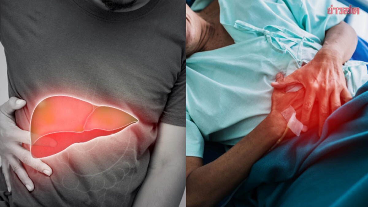 อย่าหาทำ! ชายป่วยมะเร็งตับ เคยรักษาหายด้วยสมุนไพร ปฏิเสธพบแพทย์