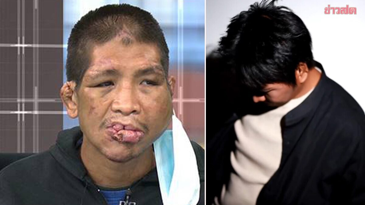 จำได้มั้ย น้องฟ้า เหยื่อนายจ้างทารุณ 15 ปี จนใบหน้ายับเยิน ล่าสุดเปลี่ยนเป็นคนละคน หลังผ่าตัด 4 ปี