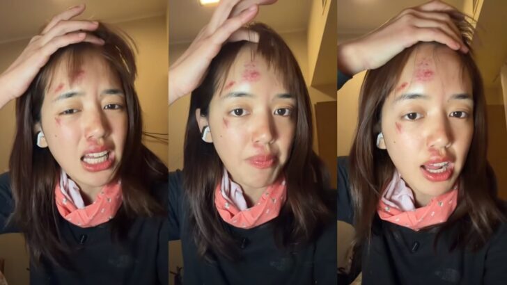 YouTuber Pigkaploy shows bruised face after Antarctic adventure: “Not a filter, real pain”