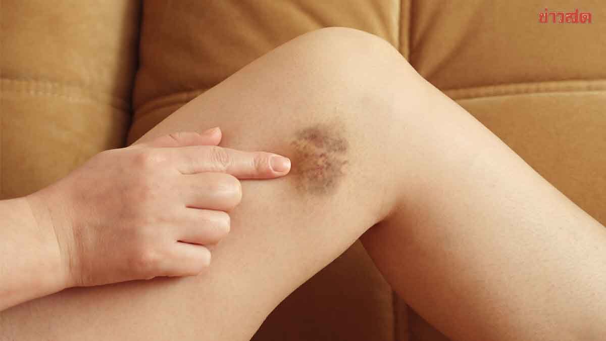รอยช้ำบนผิวหนัง อาจเป็นสัญญาณเตือน โรคมะเร็ง เผย อาการแบบไหนควรรีบพบแพทย์
