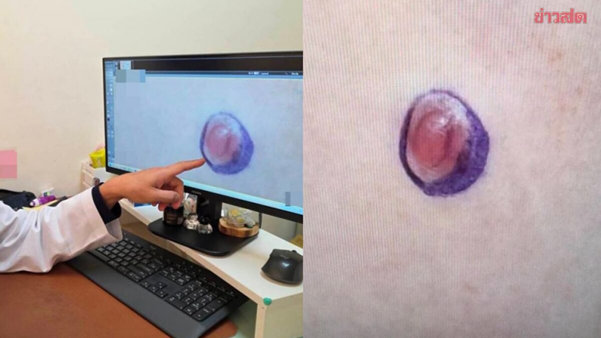 เด็กไต้หวัน คิดว่าเป็นสิวที่หน้าท้อง แกะนาน 4 เดือน ตรวจพบ มะเร็งเนื้อเยื่ออ่อน