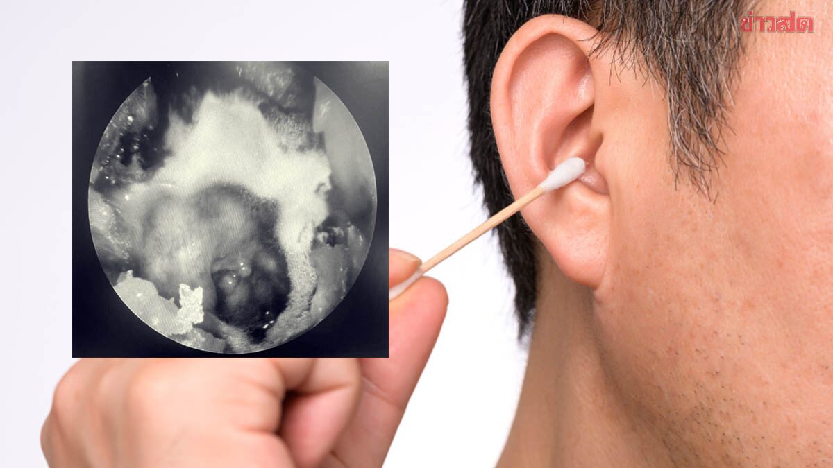 ชายหูอื้อเรื้อรังหลายเดือน แพทย์ตรวจพบ เชื้อราสีเหลือง ขึ้นบนแก้วหู