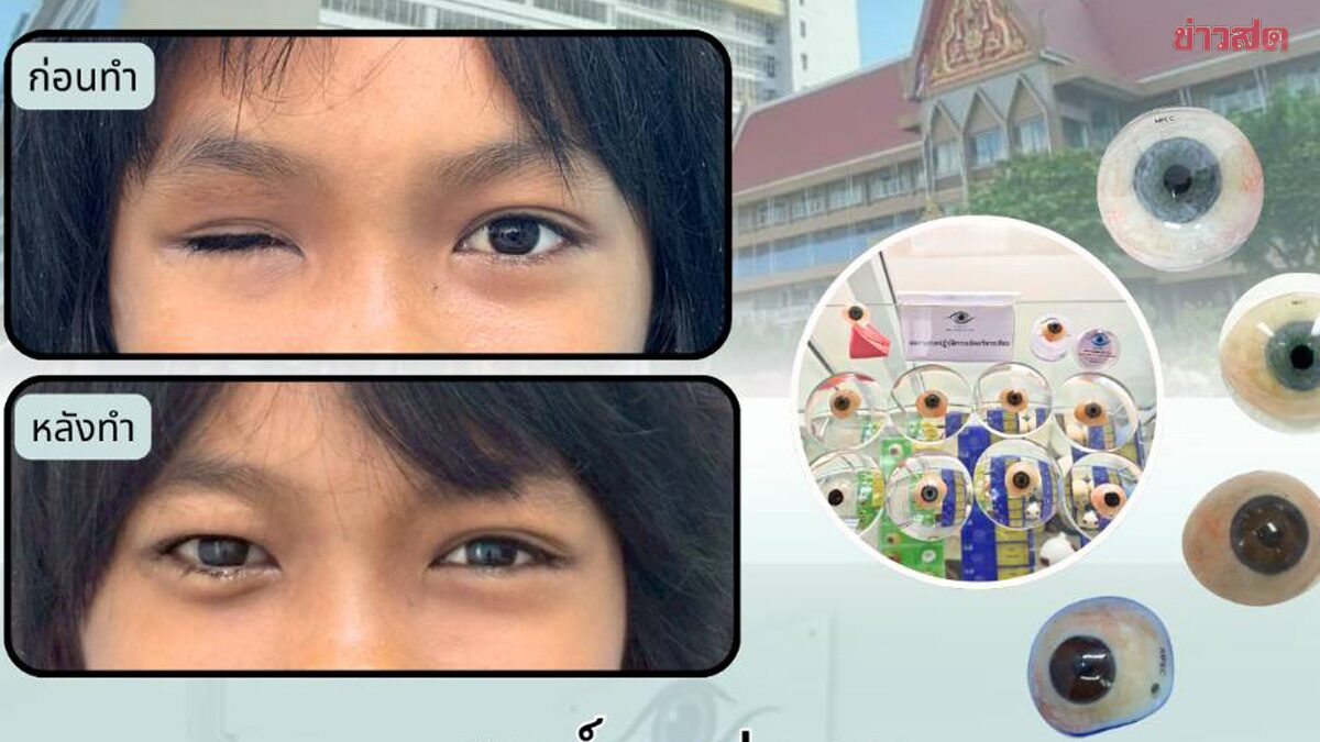 รพ.เมตตาประชารักษ์ เปิดรับทำ ‘ลูกตาปลอม’ สิทธิประกันสังคม หวังคืนความมั่นใจให้ผู้ประกันตน