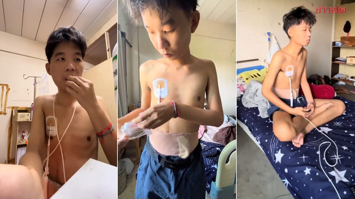 หนุ่มป่วย การ์ดเนอร์ซินโดรม มีเนื้องอกในลำไส้จนทะลุ ผ่าตัดก็กลับมาอีก รักษาไม่ได้แล้ว เล่าอาการก่อนรู้