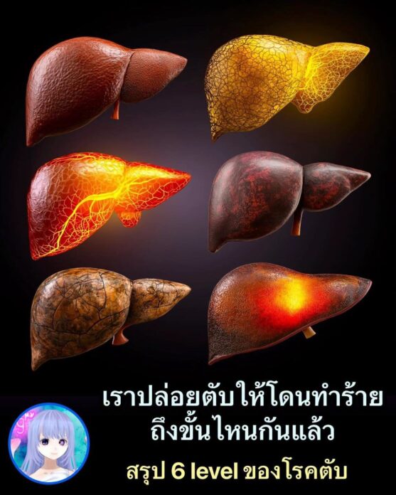 ตับพัง 6 ระดับ